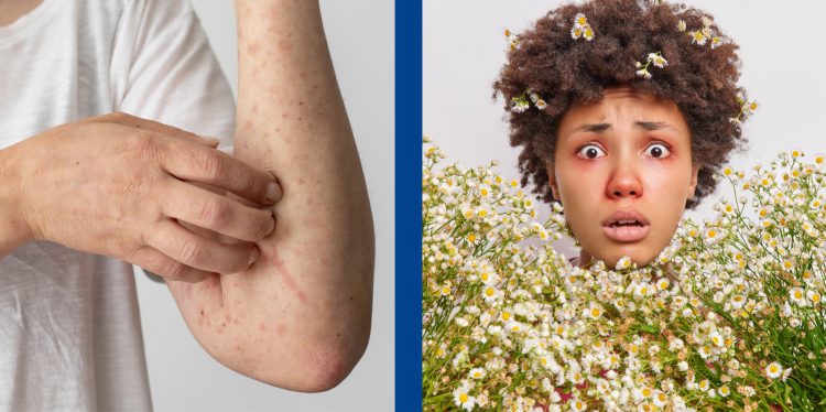 Allergie: perché nascono e come gestirle