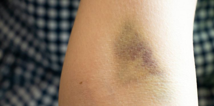 Lividi ed ematomi, perché si formano e come affrontarli