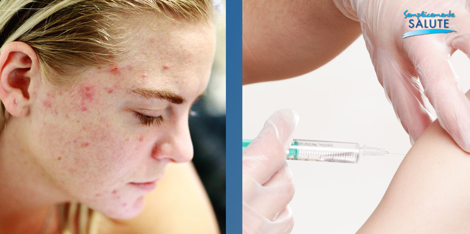 Contro acne un futuribile vaccino
