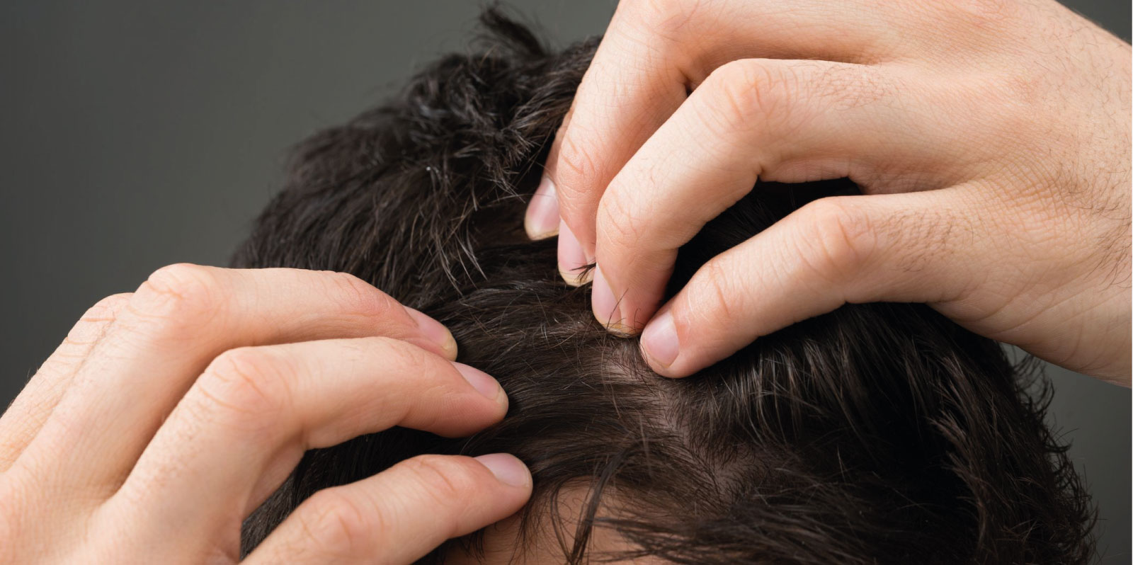 Dermatite Seborroica Da Stress Quali Sono I Sintomi
