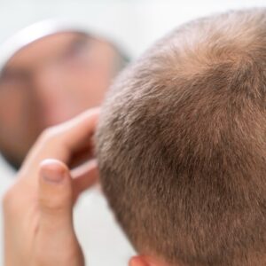 Chiazze sui capelli: quando si parla di alopecia areata