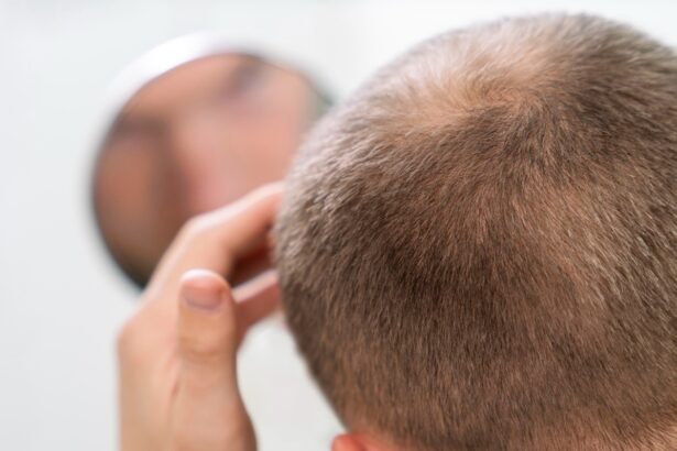 Chiazze sui capelli: quando si parla di alopecia areata