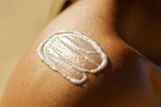 Gradi di ustioni solari: come riconoscerli e cosa fare