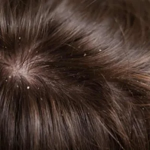 Cura del cuoio capelluto irritato
