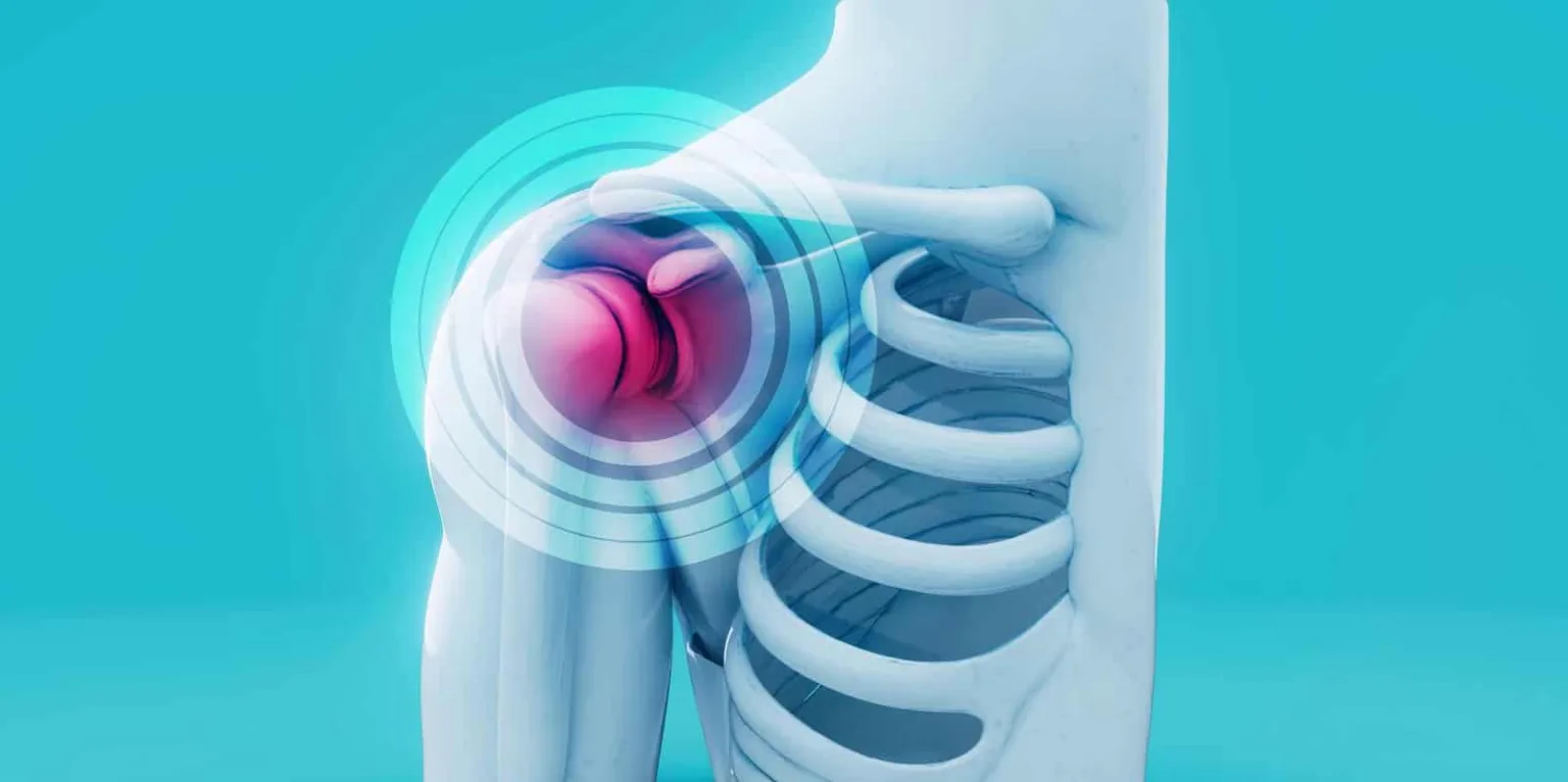 Spalla congelata: sintomi, cause e rimedi per il blocco della spalla