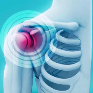 Spalla congelata: sintomi, cause e rimedi per il blocco della spalla