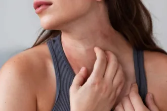 Dermatite atopica negli adulti: sintomi, cause e cosa fare