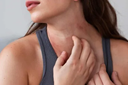 Dermatite atopica negli adulti: sintomi, cause e cosa fare