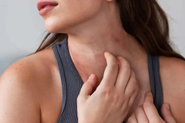 Dermatite atopica negli adulti: sintomi, cause e cosa fare