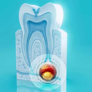 Parodontite: sintomi da riconoscere e cosa fare ai primi segnali