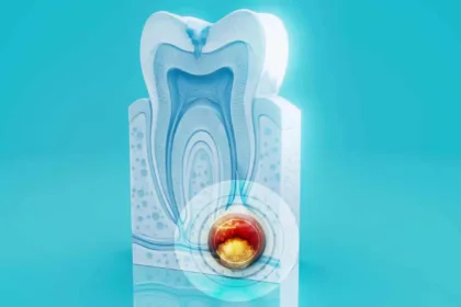 Parodontite: sintomi da riconoscere e cosa fare ai primi segnali