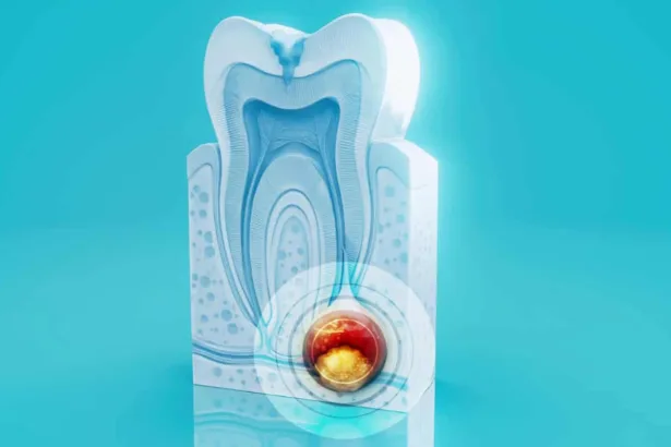 Parodontite: sintomi da riconoscere e cosa fare ai primi segnali