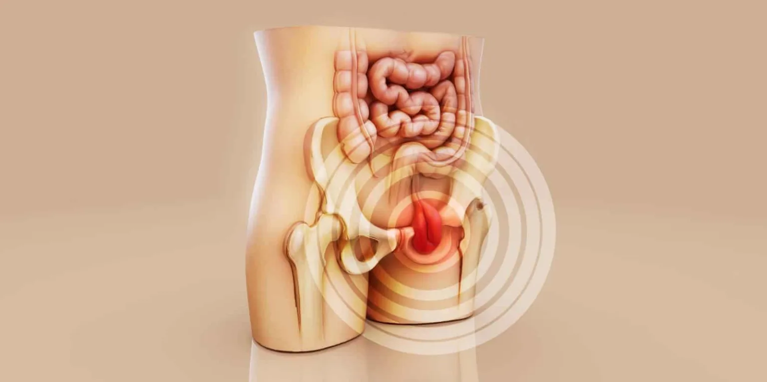 Ernia inguinale, come riconoscerla dai primi sintomi