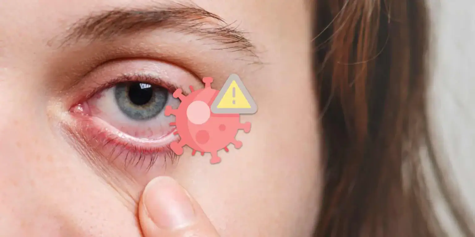 Herpes all’occhio, sintomi, cure e come prevenire le recidive