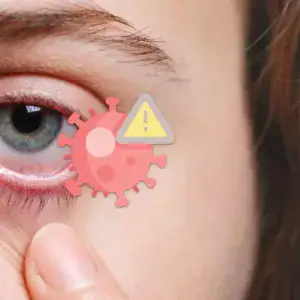 Herpes all’occhio, sintomi, cure e come prevenire le recidive