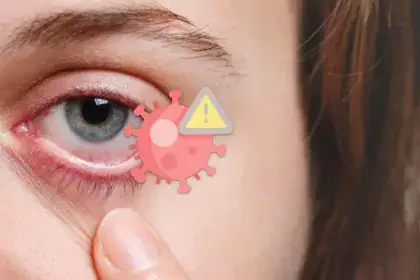 Herpes all’occhio, sintomi, cure e come prevenire le recidive
