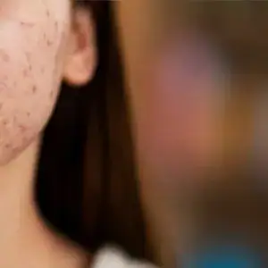 Come si sviluppa l’acne e chi rischia di più
