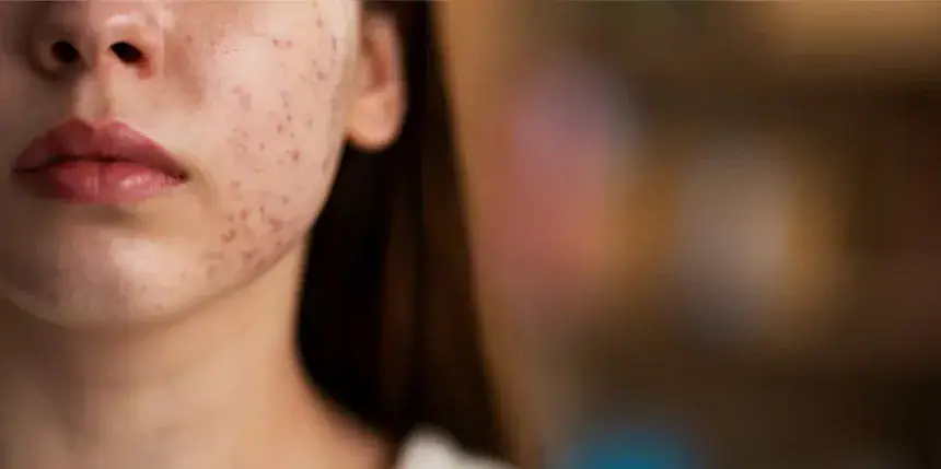 Come si sviluppa l’acne e chi rischia di più